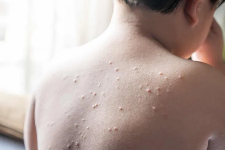 米テキサス州で“はしか”が流行、学齢期の子どもが死亡―10年ぶりの犠牲者、ワクチン接種率低下が背景に